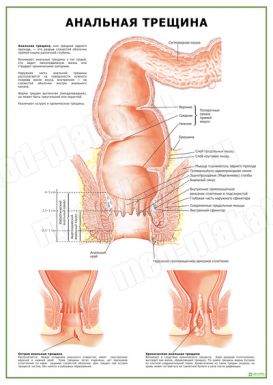 Анальная Трещина