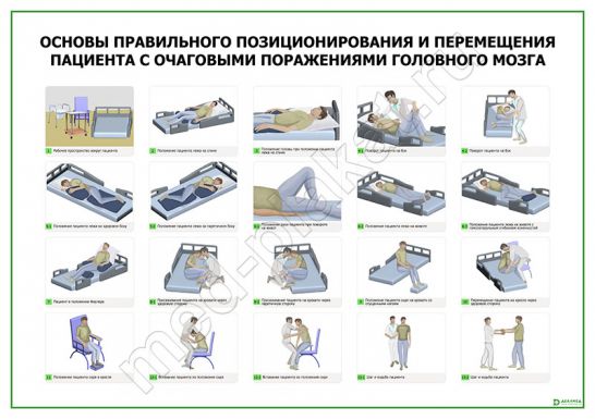 Правильное позиционирование пациента с очаговыми поражениями головного мозга