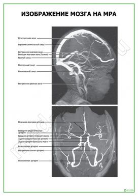 Изображение мозга на МРА