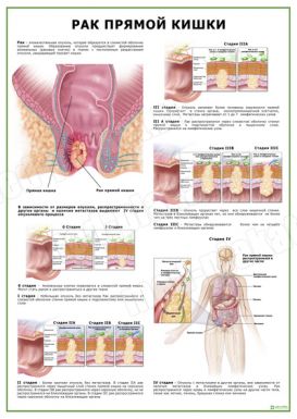 Рак прямой кишки
