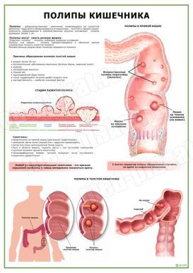 Полипы кишечника