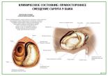Клиническое состояние: Правостороннее смещение сычуга у быка
