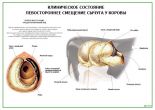 Клиническое состояние Левостороннее смещение сычуга у коровы