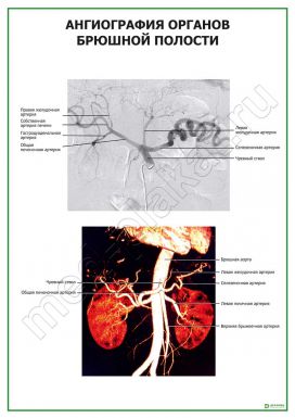 Ангиография органов брюшной полости
