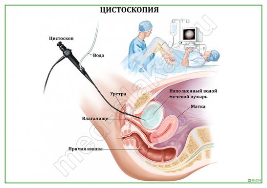 Цистоскопия