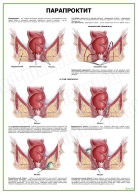 Парапроктит